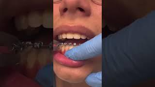 BRACES OFF‼️So Satisfying‼️️‍