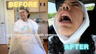 I got my wisdom teeth removed