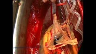 Yacoub procedure