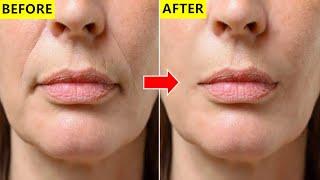 How To Get Rid Of Deep Laugh Lines (Nasolabial Folds) Fast & Naturally At Home!