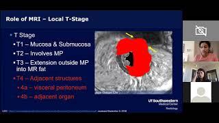 Rectal cancer MRI staging - everything you need to know!  Dr. Gaurav Khatri