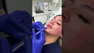 Juicy Lippies Filler Treatment by Our Cathy - Ageless MD