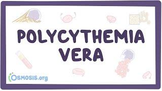 Polycythemia vera - causes, symptoms, diagnosis, treatment, pathology