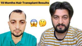 MY HAIR TRANSPLANT 19 MONTHS RESULT | Medicine i took | hair loss i faced | hair transplant journey