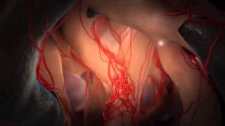 Medical 3D Animation by Infuse Medical