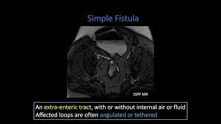 Crohn Disease Part 2:   Penetrating Disease and Mesenteric Inflammation