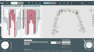 VISION in Action | Clear Aligners in Orthodontic Treatment