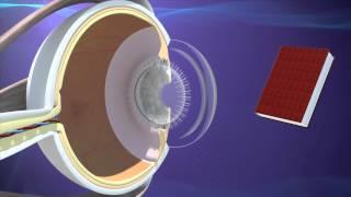 Presbyopia Treatment  for Monovision in Atlanta, GA