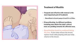 Common Breast Complications during Lactation