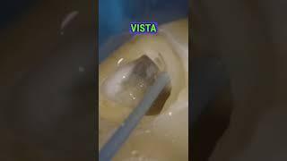 SAVE TIME WITH YOUR ENDO USING MICROASPIRATION TO DRY CANALS! 