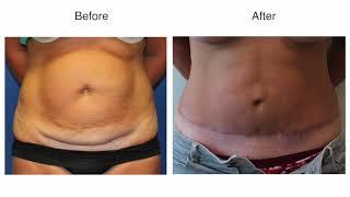 Tummy Tuck by Dr Damian Marucci