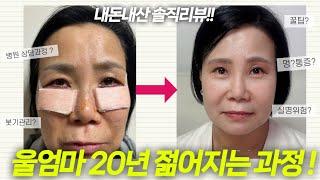 50대 엄마의 대공사 / 내돈내산 성형후기 / 붓기와의 전쟁 / (효과, 붓기, 회복기간, 흉터, 부작용, 전부 다 알려줌!)