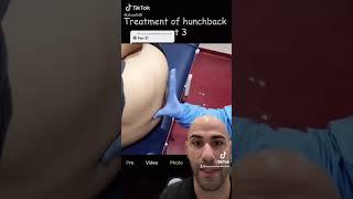 Chiropractic adjustment of severe hunchback! #hunchback #chiropractor #adjustment #viral #foryou #4u