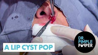 A Lip Cyst Pop