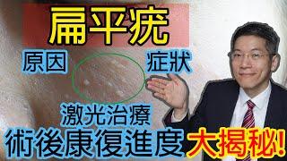 扁平疣激光治療 術後康復進度大揭秘  | 扁平疣原因 | 扁平疣症狀 | 扁平疣照片 | 扁平疣特徵 | plane warts | 陳上熙醫生 | 皮膚專科 | 手術 | Dermatologist