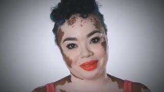 Step up for Vitiligo. Step up for Truth, Hope and Change