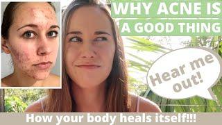 What Acne Is Telling You! (The Root Cause Approach in Naturopathy + What is Acne vulgaris)