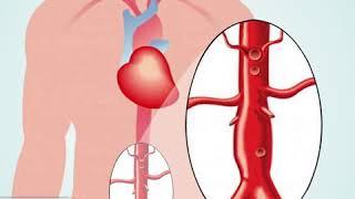 Aneurisma de Aorta