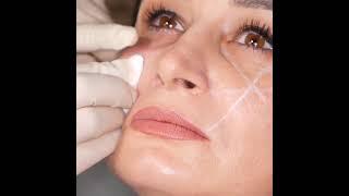 face lifting by Dr Zalmai Khan Ahmadzai Skin and Aesthetics specialist Kabul Afghanistan