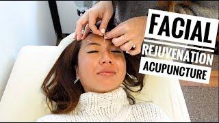 FACIAL REJUVENATION ACUPUNCTURE (Review and Cost)