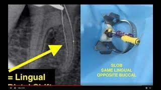 How to determine root canal working lengths with X-rays.