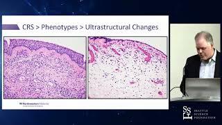 Endotypes in CRS  Bench to Bedside - Kevin Welch, MD