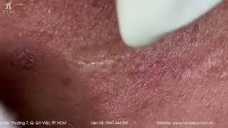 Big Cystic Acne Blackheads Extraction Blackheads & Milia, Whiteheads Removal Pimple Popping