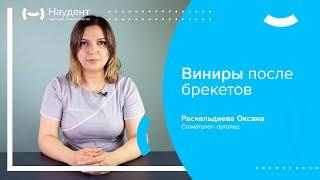  Виниры после брекетов