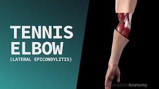 Tennis Elbow (Lateral Epicondylitis)