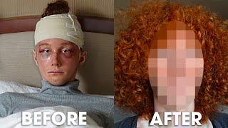 *RESULTS* Before and After MORE Facial Feminization Surgery in South Korea | Season 2, EP 2