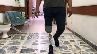 Osseointegration surgery for below knee amputee in Iraq.