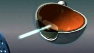 Stanford Hospitals and Clinics: laser vision correction: LASIK Hartmann