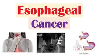 Esophageal Cancer | Risk Factors, Pathogenesis, Signs and Symptoms, Diagnosis, Treatment