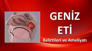 GENİZ ETİ Belirtileri ve Ameliyatı