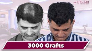 Dense and natural results from the best hair transplant clinic Eugenix Hair Sciences