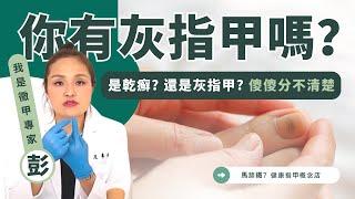 是乾癬? 還是灰指甲? 傻傻分不清楚｜馬蹄鐵7健康指甲概念店