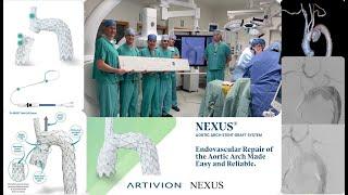 Aortic Arch Aneurysm  with Artivion Endospan Nexus Duo The“IDEALIST” Arch Endograft