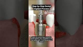 Step-by-Step Dental Implant Process #DentalImplants #OralSurgery #DentalCare #SmileRestoration