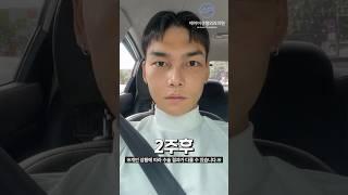 남자 비절개 눈매교정 후기 #shorts