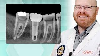 How to Identify Dental Implants