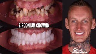 ZIRCONIUM CROWNS TREATMENTS | SMILE MAKEOVER IN ANTALYA TURKEY