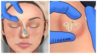 [ASMR] Acne, Big Blackhead Removal Animation