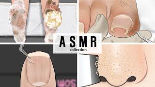 [ASMR] 인기많은 케어 애니메이션 모음집/발 각질,여드름,코 피지,티눈 케어 / Ingrown toenail, Acne, Whiteheads, Feet exfoliation