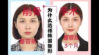 削骨磨骨轮廓整形后续｜韩国整形术后三个月记录