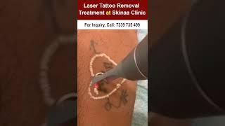 Laser Tattoo Removal at Skinaa Clinic #viralshorts  #lasertattooremoval #skinaaclinic #shorts