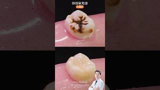 tooth decay - resin restoration