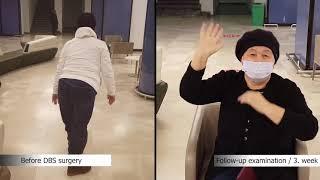 Change of Parkinson Patient Roza KOZHOKMANOVA with DBS Treatment | Doç. Dr. Ali ZIRH
