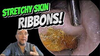 STICKY SKIN RIBBONS! 310 #ear #earwax #earwaxremoval #earcleaning #asmr #foryou #satisfying