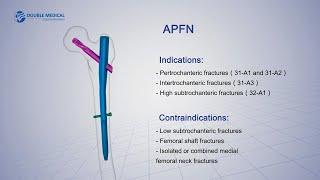 Double Medical APFN ( Aimstrong Proximal Femoral Nail)