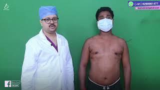 Gynecomastia Result In Kolkata || Dr. Jayanta Bain plastic & cosmetic surgeon